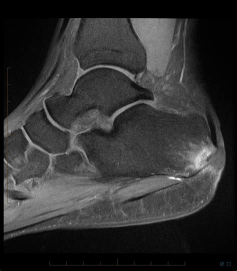 Radiology Cases Calcaneal Osteomyelitis