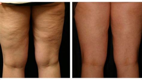 this homemade treatment will remove your cellulite after only 7 days of use youtube