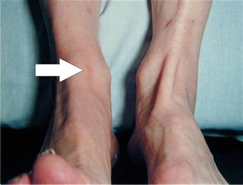 Anterior Tibialis Tendon Rupture Foot Ankle Orthobullets