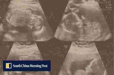 Wanita Hamil Kembar 4 Lahirkan 2 Bayi 2 Lagi Masih Dalam Kandungan