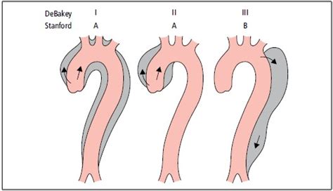 Rozpoznawanie i leczenie chorób aorty wytyczne ESC 2014 Część 4