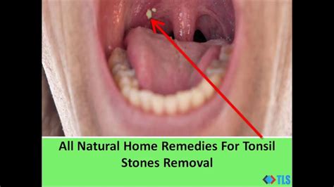 What Causes White Blotches On Tonsils Throat Remedy Sore Herbal