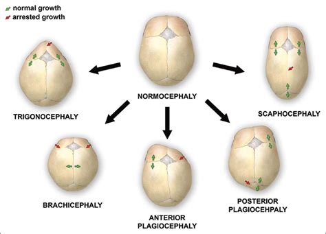 Craniosynostosis Recognition Clinical Characteristics And Treatment