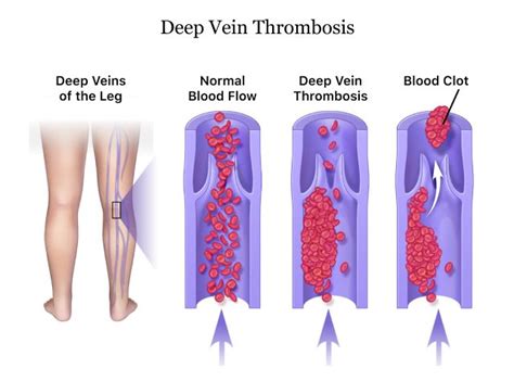 Deep Vein Thrombosis Dvt Warnings Signs And Treatment