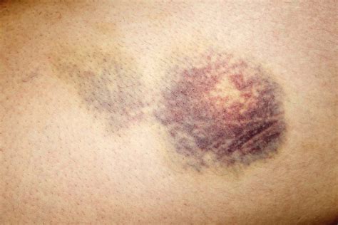 Causes Of Purpura Purple Spots On Skin
