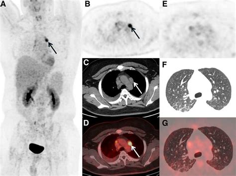 Only A Few Hypermetabolic Lymph Nodes And Nodules Remained Existing In