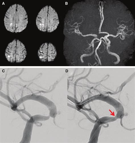 Initial Mri And Intraoperative Findings Of The Balloon Angioplasty A