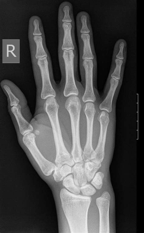 X Ray Of The Right Hand Academy Of American Poets