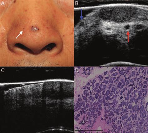 Micro Nodular Basal Cell Carcinoma Clinical A Ultrasonographic B