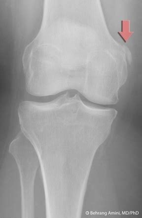 The cause of the knee effusion is unknown. Pellegrini-Stieda Lesion (X-Ray of Knee) - radRounds ...