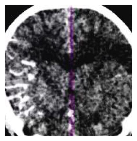A 58 Year Old Male Patient With Left Limb Weakness And Unclear Speech