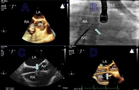 The Use Of Real Time Three Dimensional Transesophageal Echocardiography