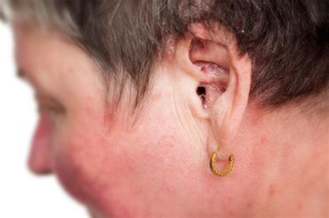 Psoriasis In The Ears Treatment And Symptoms