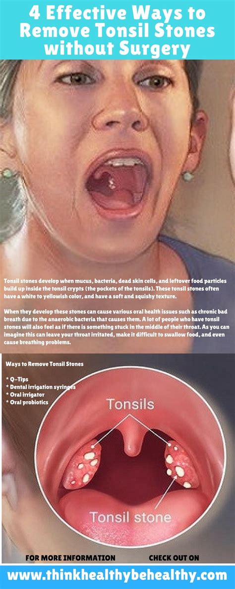 Cool What Do Tonsil Stones Feel Like