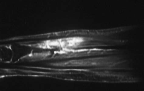 Hemangioma Of Soft Tissue Pathology Orthobullets