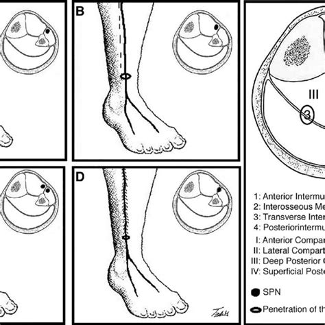 Pdf Entrapment Of The Superficial Peroneal Nerve
