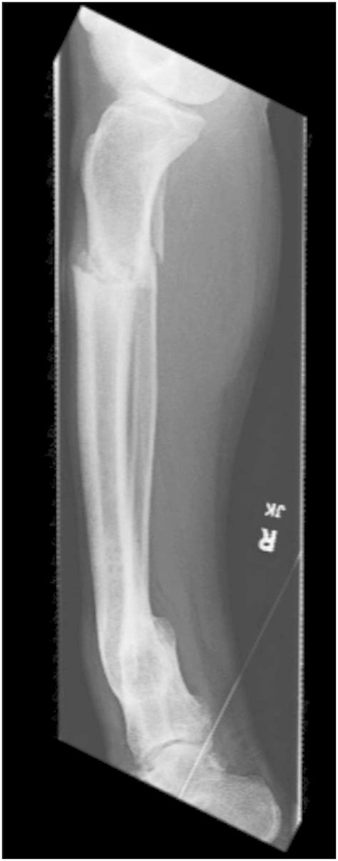 Jbjs Distal Tibial Metaphyseal Malunion Treated With Clamshell Osteotomy