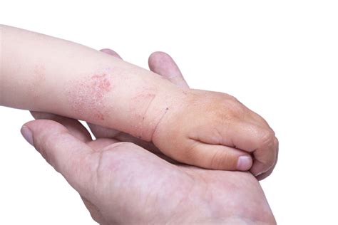 Pediatric Atopic Dermatitis Clearing The Obstacles And Addressing