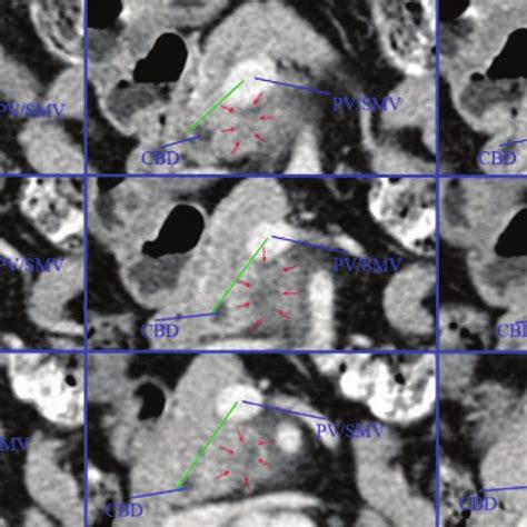 The Ct Scan Image Of Pancreatic Head Cancer Arising From Dorsal