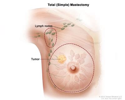 See how breast cancer metastasis affects the body, possible. Surgery Choices for Women with DCIS or Breast Cancer ...
