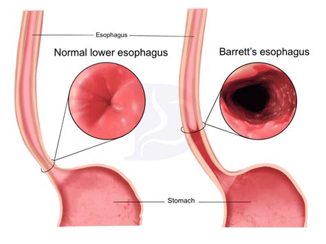 Barretts Esophagus Causes And Treatment Digestive And Liver Health