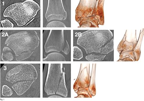 Posterior Malleolar Ankle Fractures Semantic Scholar