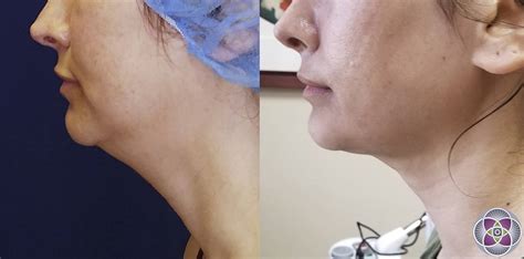 Facetite And Necktite Non Surgical Jowl And Neck Tightening