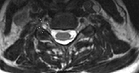 Symptomatic Cervical Perineural Tarlov Cyst A Case Report