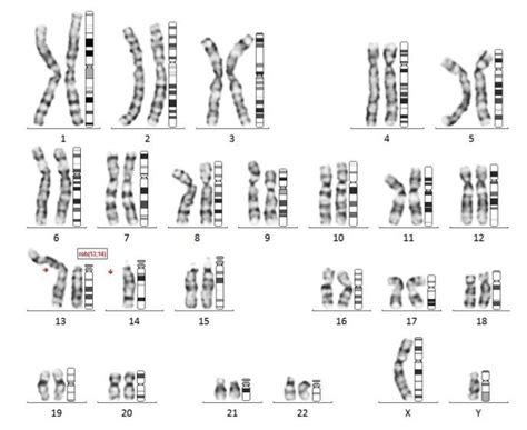 What Does An Abnormal Karyotype Show Karyotypinghub Chromosome Chromosomal Abnormalities