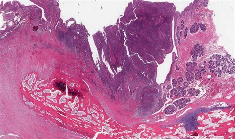 Hpv Associated Squamous Cell Carcinoma Of The Larynx Atlas Of Pathology