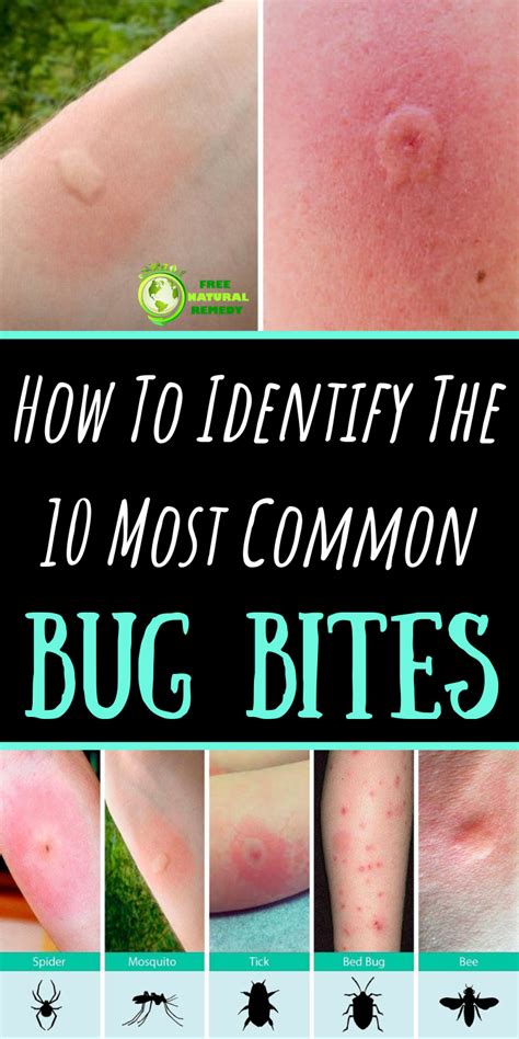 How To Identify The 10 Most Common Bug Bites Remedies For Bee Stings