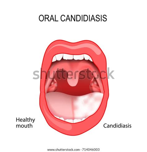 Oral Candidiasis Oral Thrush Healthy Mouth Stock Vector Royalty Free