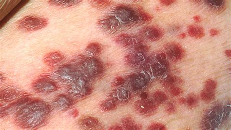 What Do Hiv Skin Lesions Look Like
