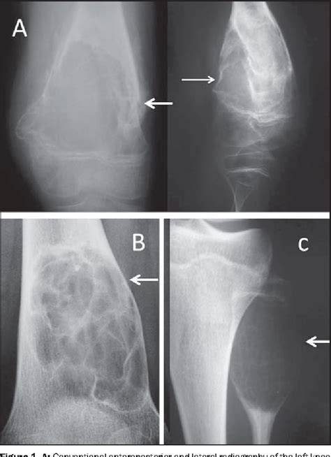 Figure 3 From Knee Bone Tumors Findings On Conventional Radiology