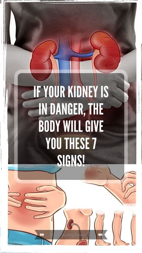 9 Signs You May Have Kidney Disease Kidney Stones Symptoms Kidney
