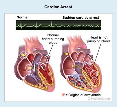 Sudden cardiac arrest (sudden cardiac death). Cardiac Arrest; Causes, Types And Treatment. - INFORMATION ...