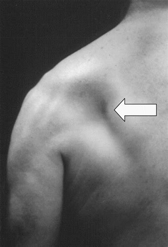 Suprascapular Neuropathy Shoulder And Elbow Orthobullets