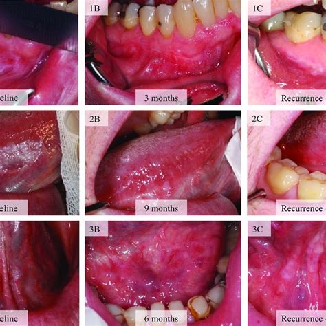 Clinical Presentation Of Homogeneous Leukoplakia A And Download