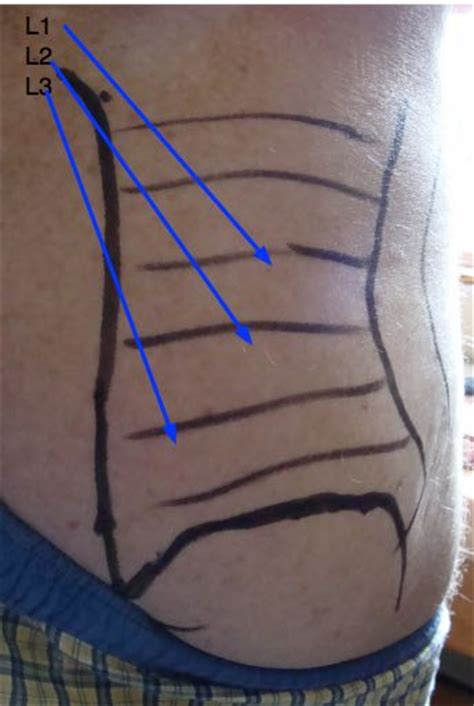 The vertebral column runs the length of the back and creates a central area of recession. Superior cluneal nerves supply part of the skin of the ...