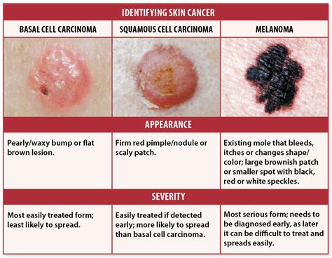 3 Types Of Skin Cancer Quizlet Skinsj