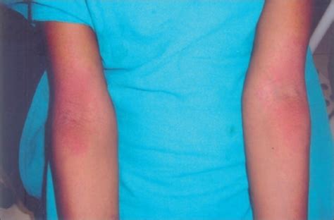 Urticaria Chronic Hives Causes Types Diagnosis And Treatment