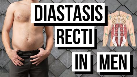 Diastasis Recti In Men Over 35 Fix Your Belly Bulge Youtube
