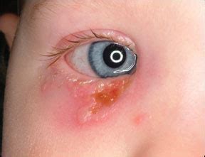 Stop application of oil on the skin. A healthy 11-year-old female presents with a rash about the face