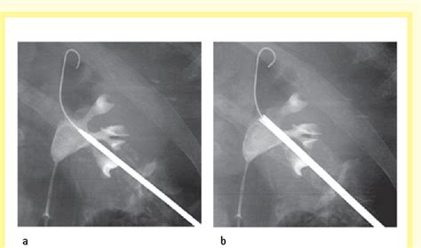 Figure 10 From Surgical Atlas Percutaneous Nephrolithotomy The