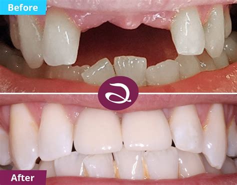Cosmetic Dentistry Before And After From The Aspects Dental Clinic In Milton Keynes Cosmetic