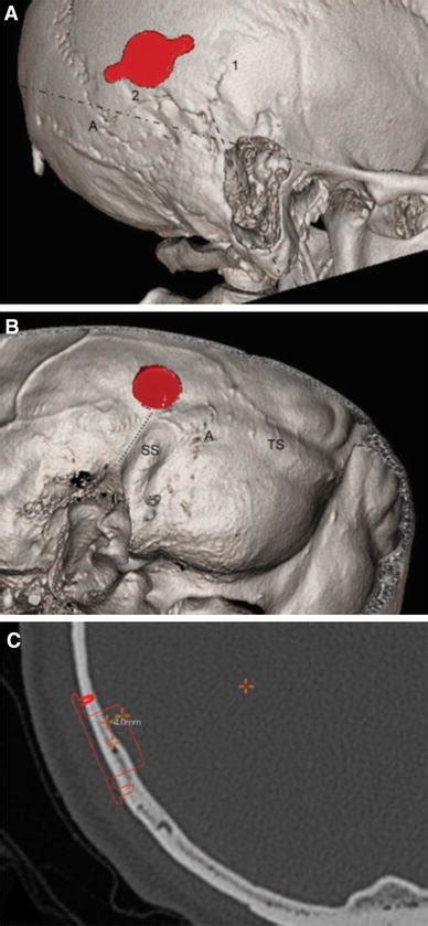 Positioning Of The Template At The Parietal Localization A 3d Bone