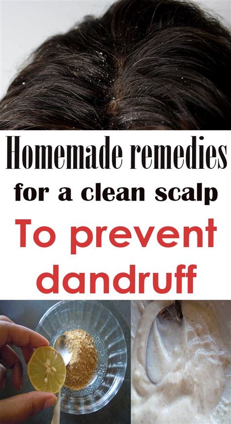 Homemade Remedies For Dandruff Prevention Simple Tips For You