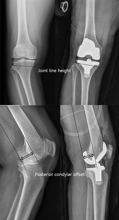 Posterior Tibial Slope Is A Modifiable Predictor Of Relatively Large Extension Gaps In Total