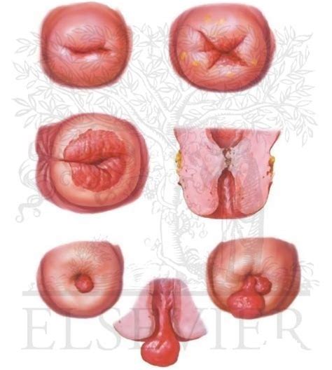 يقوم جهاز المناعة في معظم الحالات، بالقضاء على الفيروس hpv قبل أن يتمكن من تكوين الثآليل. لحمية عنق الرحم كيف نشخصها ونتعرف عليها - المرسال