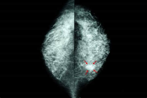Ai Improves Radiologists Readings Of Mammograms Axis Imaging News